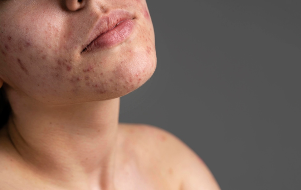 Mujer con acné