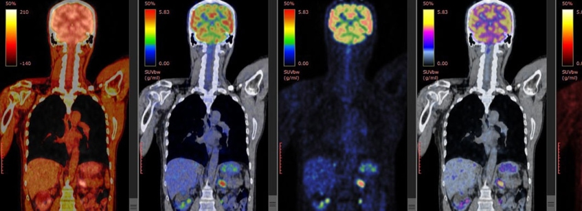 Examen PET-CT