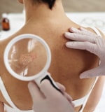 Doctor examinando lunares